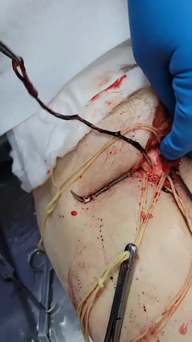 Unbelievable blood clots: video from embalmer Richard Hirschman