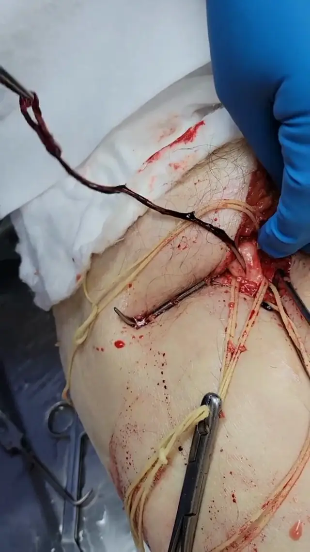 Embalmer Richard Hirschman Removes Unbelievable Blood Clot From Deceased Body